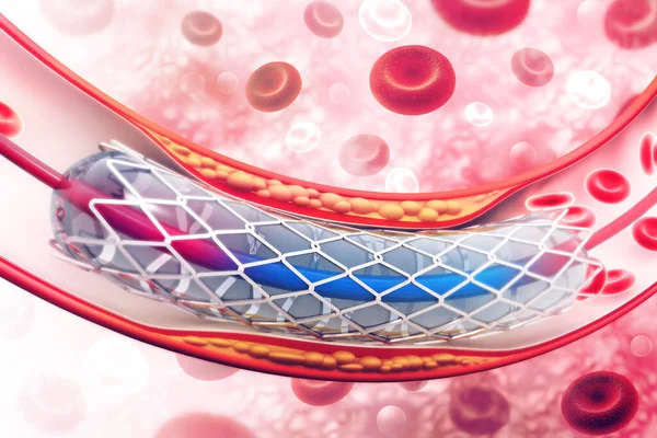 Stent Anjiyoplasti Illüstrasyon — Stok fotoğraf