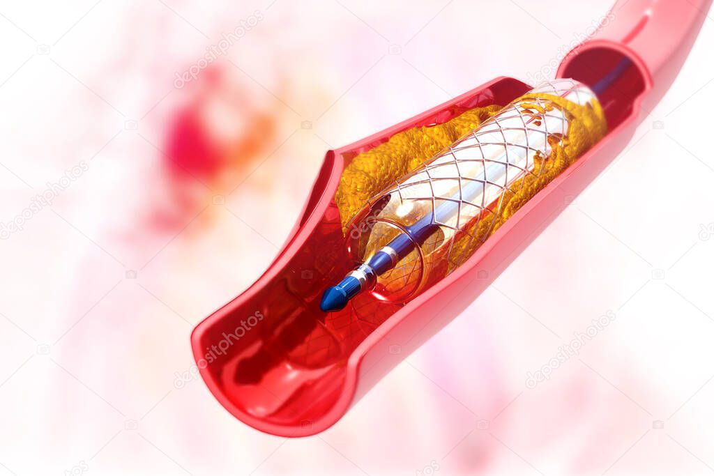 Stent angioplasty. 3d illustratio