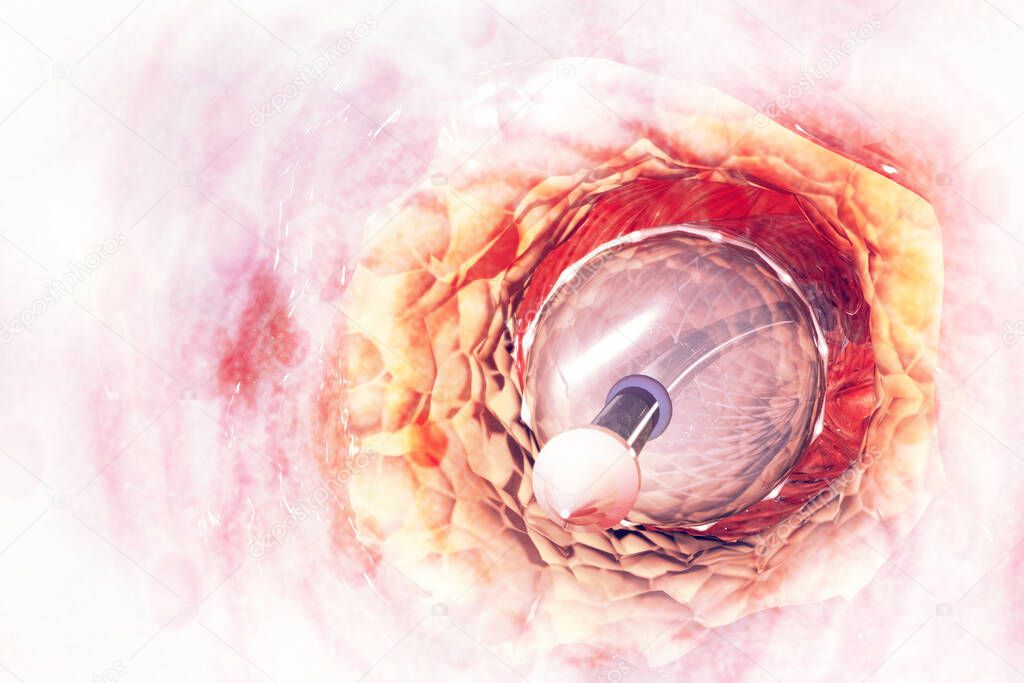 Stent angioplasty. 3d illustratio