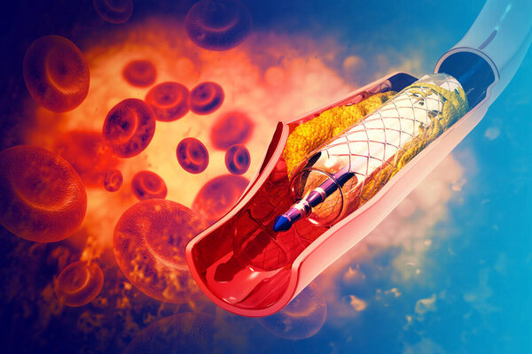 Стентовая ангиопластика. 3d иллюстрация
