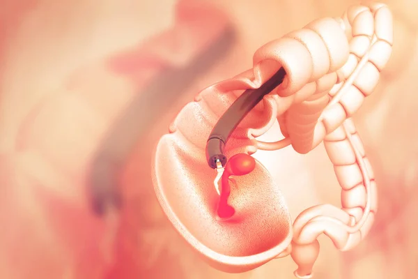 結腸がんです 結腸内の大腸内視鏡 ポリプリムーバー3Dイラスト — ストック写真