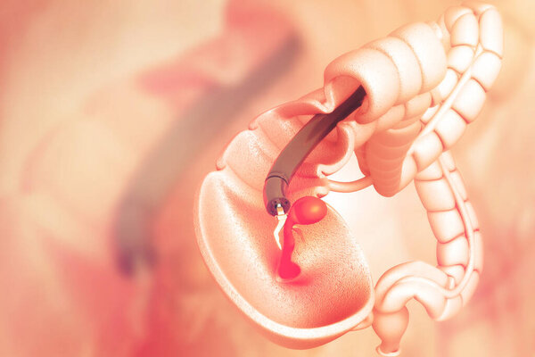 colon cancer. colonoscope in the colon. polyp removal.3d illustration
