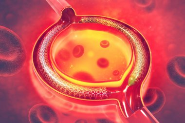 Stent anjiyoplasti. 3d illüstrasyon