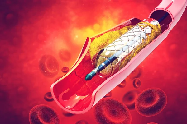 Angioplastie Des Endoprothèses Illustration — Photo