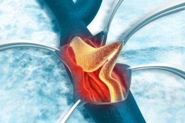 Arterde kolesterol plağı var. Plaketi kaldırıyorum. 3d illüstrasyon