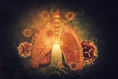 Virus and bacteria infected the Human lungs. lung disease.3d render clipart