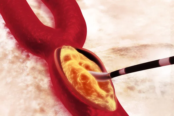 Tablica Cholesterolowa Tętnicy Usuwam Tablicę Ilustracja — Zdjęcie stockowe