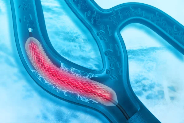 Stentní Angioplastika Ilustrace — Stock fotografie