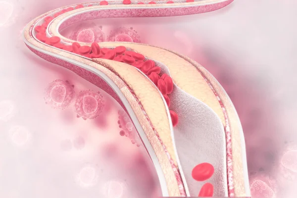 动脉内的胆固醇斑块 3D说明 — 图库照片