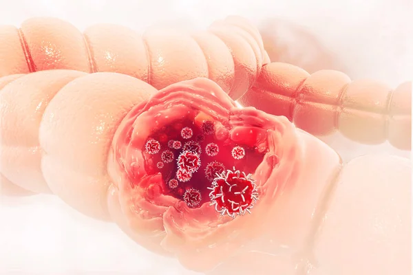 Colon cancer. Cancer attacking cell. Colon disease concept. 3d illustration