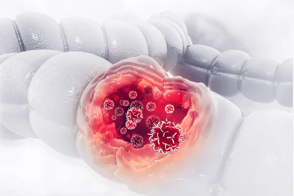 Colon cancer. Cancer attacking cell. Colon disease concept. 3d illustration