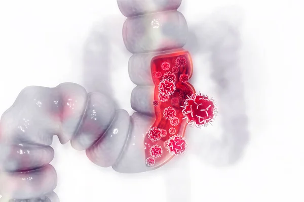 Рак Товстої Кишки Рак Атакує Клітину Концепція Колонної Хвороби Ілюстрація — стокове фото