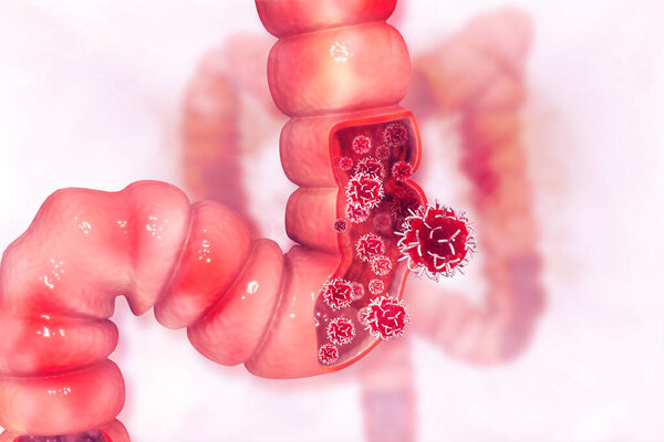 Colon cancer. Cancer attacking cell. Colon disease concept. 3d illustration 