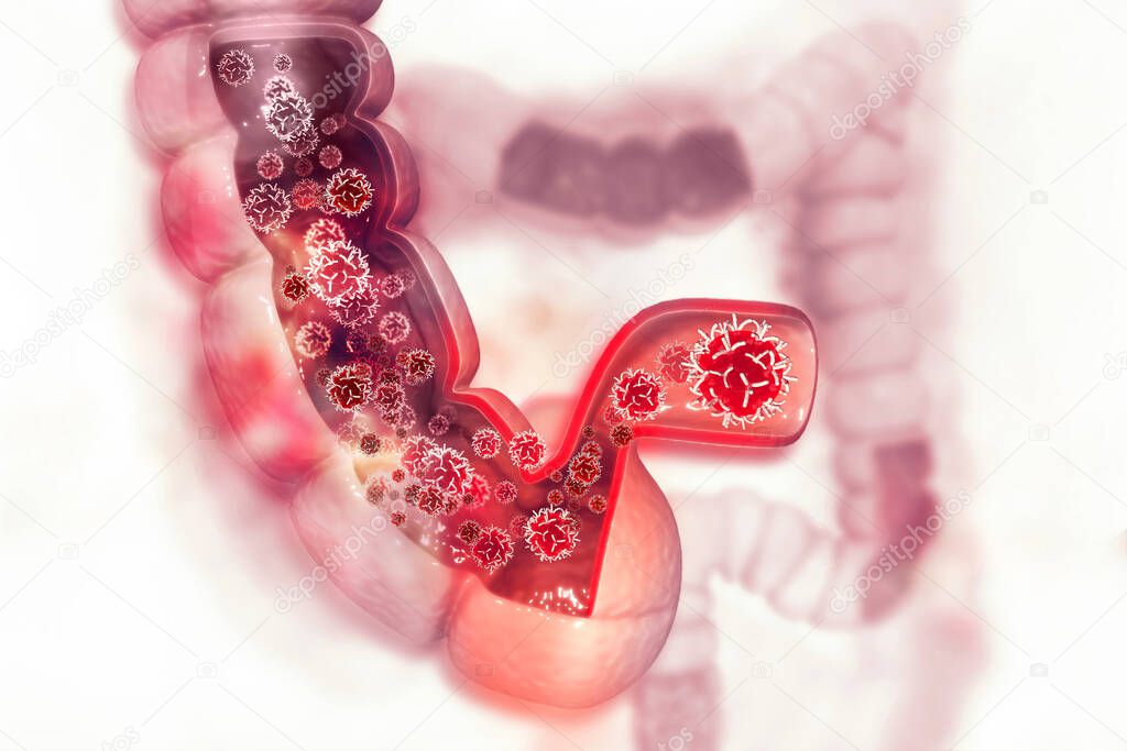 Colon cancer. Cancer attacking cell. Colon disease concept. 3d illustration 