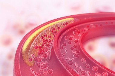 Arterde kolesterol plağı var. 3d illüstrasyon