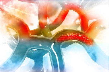 Stent anjiyoplasti.3d çizim