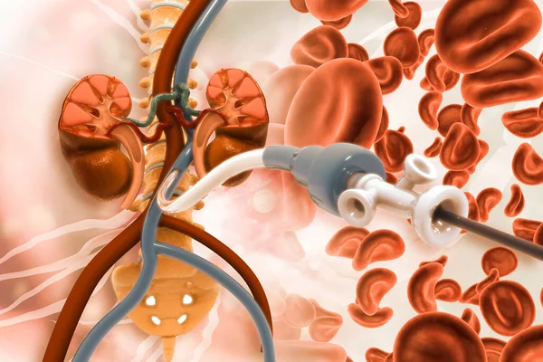 Angioplastia Stent Doença Arterial Periférica Ilustração — Fotografia de Stock