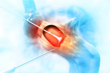 İnsan dizi eklem ameliyatı. 3d illüstrasyon