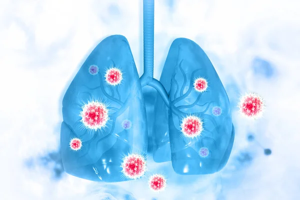 Virus Bacteria Infected Human Lungs Lung Disease Render — Stock Photo, Image