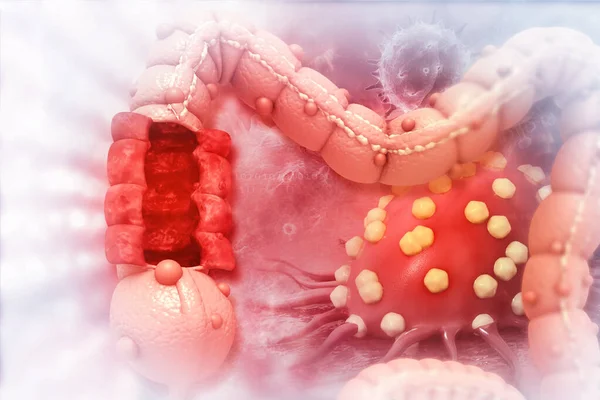 Colonkanker Kanker Valt Cel Aan Concept Darmziekte Illustratie — Stockfoto