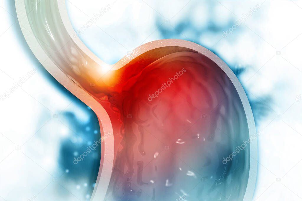 Cholesterol plaque in artery. Stomach cross section. 3d illustration