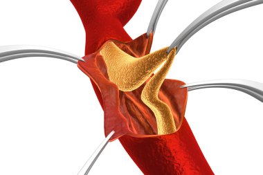 Arterde kolesterol plağı var. Plaket kaldırılıyor