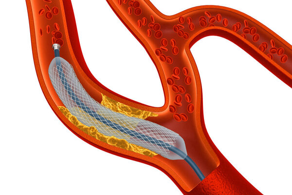 Balloon Expandable Stent. Anatomical concept