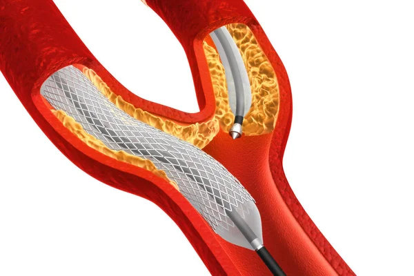 Balon Genişletilebilir Stent. Anatomik kavram