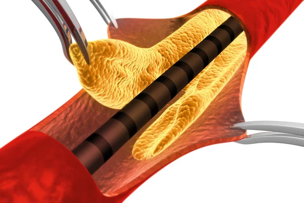 Tablica Cholesterolowa Tętnicy Usuwanie Tablicy — Zdjęcie stockowe