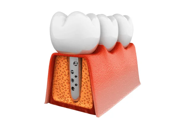 Estructura Del Implante Dental Renderizar — Foto de Stock