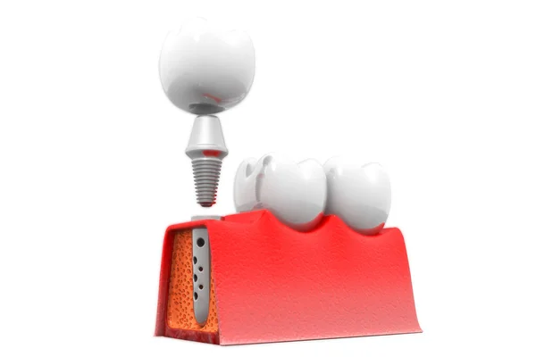 Estrutura Implante Dentário Renderização — Fotografia de Stock