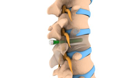 Omurga implantı, vida yerleştirme, 3 boyutlu illüstrasyon