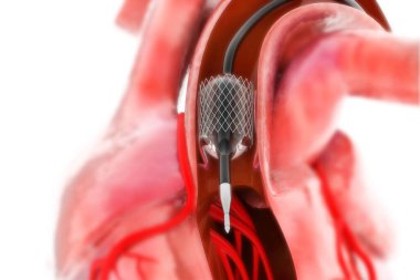 Balon Genişletilebilir Stent. Anatomik kavram