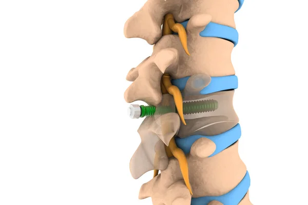 Columna Vertebral Con Implante Colocación Tornillo Ilustración — Foto de Stock