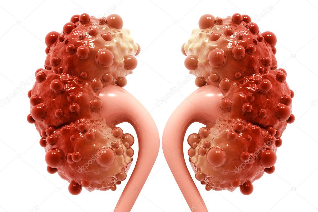 kidney disease on white background