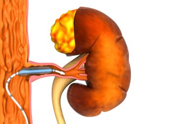 Stent anjiyoplasti. Çevresel arter hastalığı