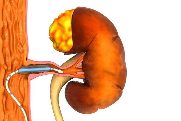 Angioplastyka Stentu Choroba Tętnic Obwodowych — Zdjęcie stockowe