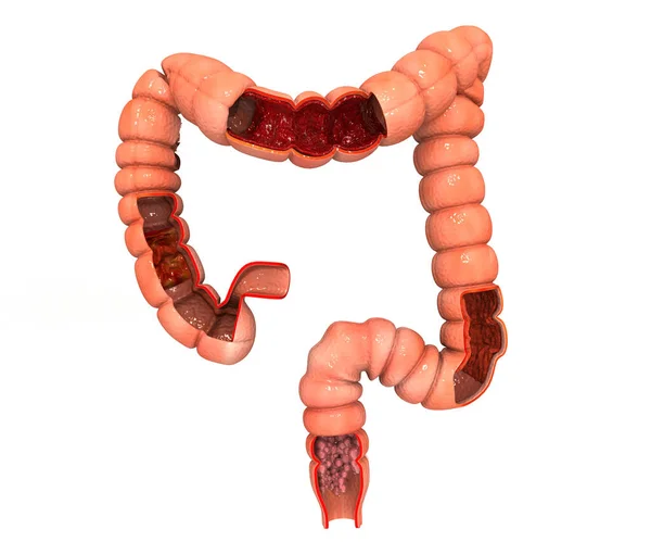 Cancro Colon Cancro Che Attacca Cellule Concetto Malattia Del Colon — Foto Stock