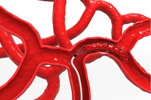 Angioplastia Del Stent Ilustración — Foto de Stock