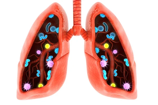 Virus Bacteria Infected Human Lungs Lung Disease Render — Stock Photo, Image