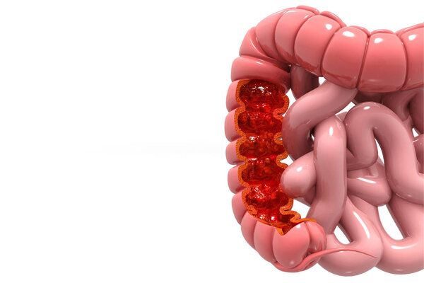 Colon cancer. Colon disease concept. 3d illustration 