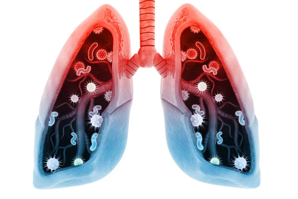 Virüs Bakteri Insan Ciğerlerine Bulaştı Akciğer Hastalığı Oluşturucu — Stok fotoğraf