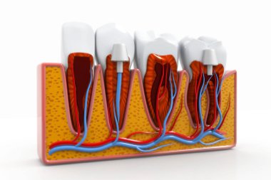 Diş implantı yerleştirme işlemi. 3d hazırlayıcı