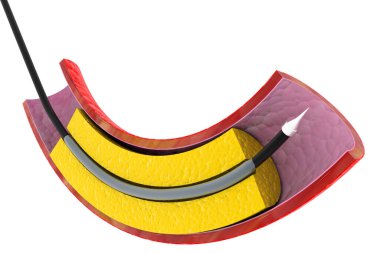 Balon Genişletilebilir Stent. Anatomik konsept. 3d hazırlayıcı