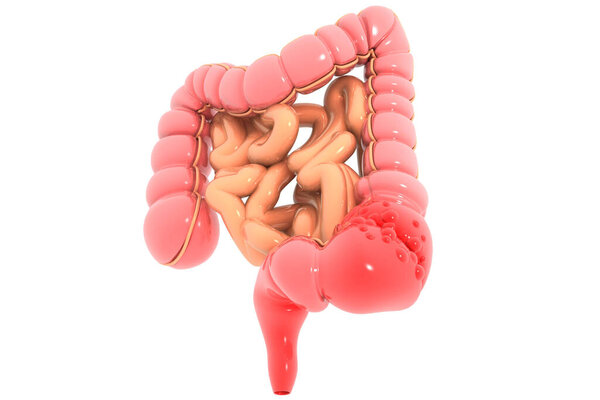 Colon cancer. Cancer attacking cell. Colon disease concept. 3d illustration 