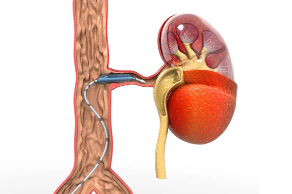 Angioplastia Con Stent Enfermedad Arterial Periférica Ilustración —  Fotos de Stock