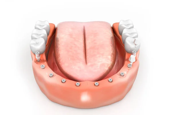 Processo Instalação Implante Dentário Rende — Fotografia de Stock