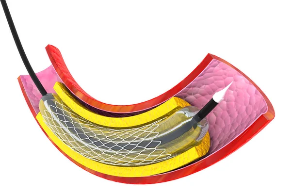 Balon Genişletilebilir Stent Anatomik Konsept Rende — Stok fotoğraf