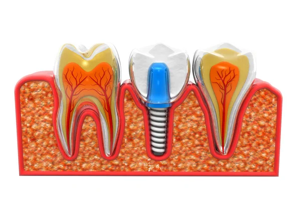 Processo Instalação Implante Dentário Renderização — Fotografia de Stock