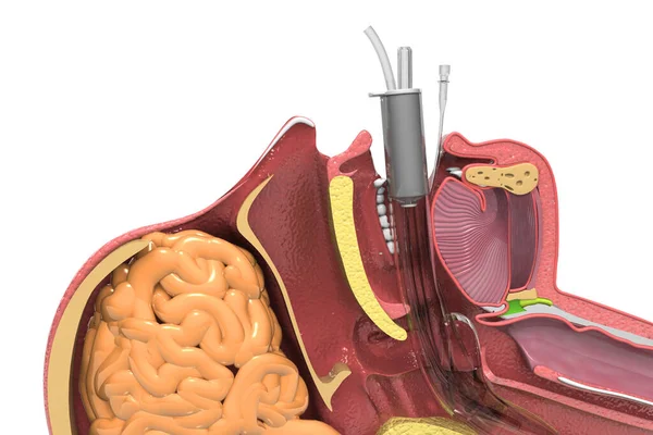 Intubação Endotraqueal Secção Transversal Cabeça Humana Renderização — Fotografia de Stock